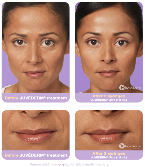 Juvederm