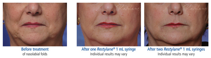 Restylane2